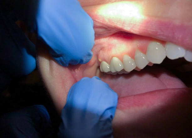 Best Emergency Dental Care for Broken or Chipped Teeth in Pike Road, AL